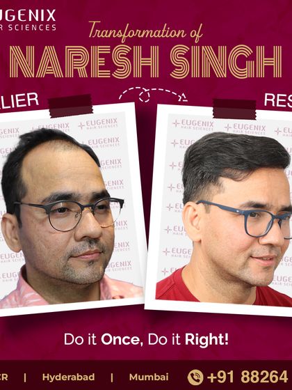 The complete transformation of Naresh Singh, showcasing a restored hairline and renewed look.