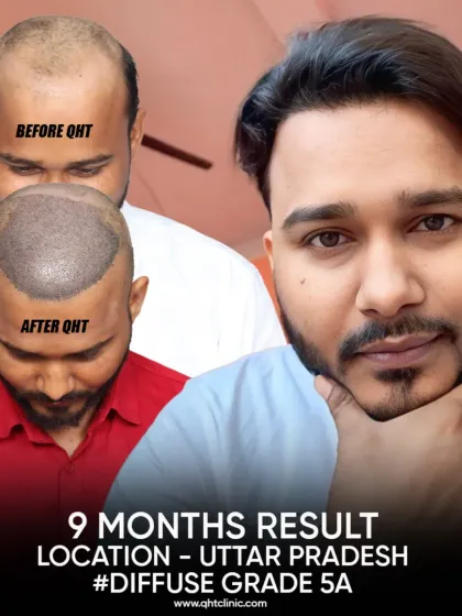 A 9-month result for a Diffuse Grade 5A patient from Uttar Pradesh, who received 5000 grafts for full mid-scalp coverage and hairline restoration.