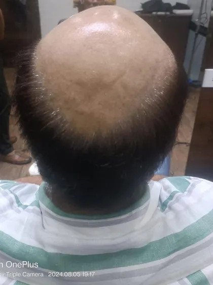 This is the 'before' stage for a client with advanced androgenetic alopecia. The scalp is prepared and ready for the application of a custom non-surgical hair system.