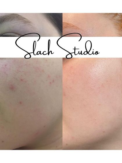 A great example of how the treatment helps to clear up post-acne redness and spots for a smooth, even finish.