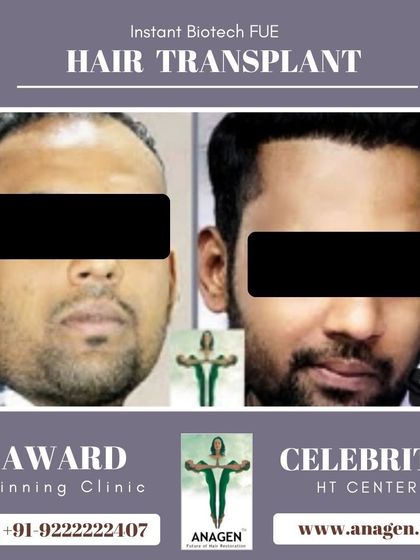 A perfect and natural hairline achieved with our Instant Biotech FUE hair transplant. This before and after comparison highlights our expertise in hairline design.