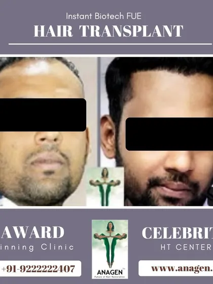 A perfect and natural hairline achieved with our Instant Biotech FUE hair transplant. This before and after comparison highlights our expertise in hairline design.