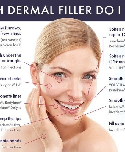 This chart helps explain which type of dermal filler is best suited for different concerns, from softening nasolabial folds to plumping the lips. I select the right product to achieve soft, natural, and lasting results.