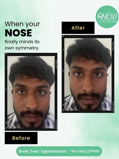 This before-and-after of a nose correction shows how subtle tweaks can create a significant shift in confidence. The goal is always balance, proportion, and natural refinement.