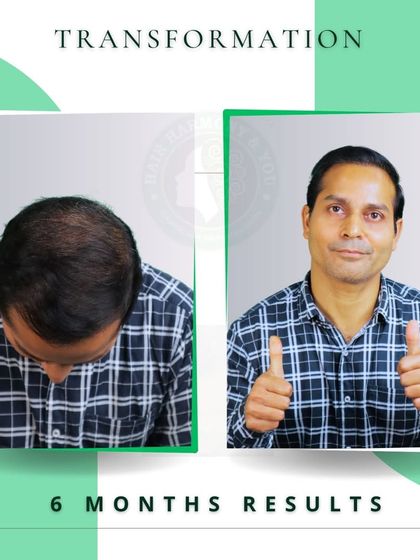 Just six months post-procedure, and the results are already fantastic. This image shows significant new growth and density, demonstrating how quickly you can start enjoying the benefits of an FUE transplant.