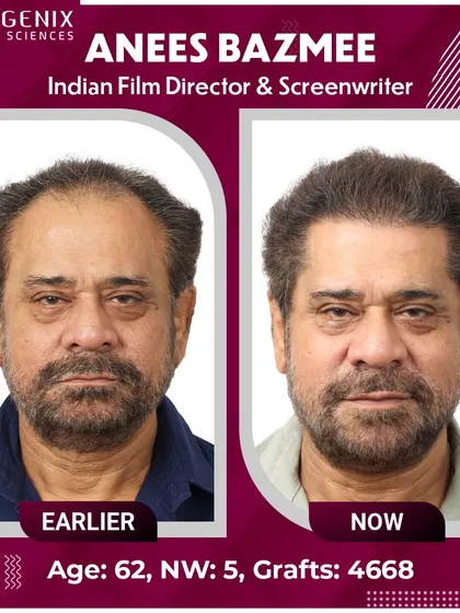 We are proud to be the choice of icons. Here is the remarkable transformation of esteemed Indian Film Director, Anees Bazmee. We addressed his Grade 5 hair loss with 4,668 grafts, creating a result that is as masterful as his films.