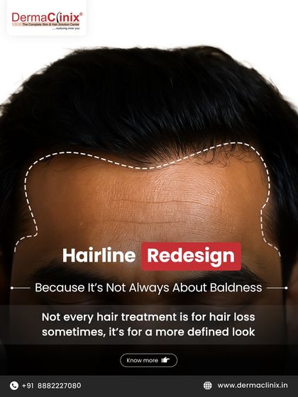 Hairline redesign is not always about treating baldness. Sometimes, it's about refining and defining your look. We use precision and an eye for symmetry to create a sharper, more aesthetic hairline.