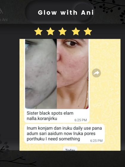 "Black spots ellam nalla koranjirku" (The black spots have reduced a lot). This is the kind of message that makes my day. Seeing my products help clear up skin concerns is my goal.