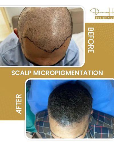 Hair Restoration & Treatment