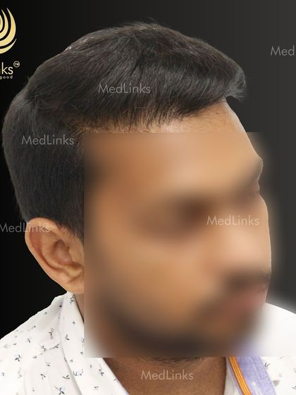 The final result from the side, showing a natural and full head of hair.