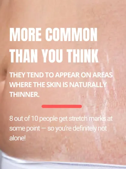 Stretch marks are more common than you think, affecting about 8 out of 10 people at some point in their lives. They often appear on areas where the skin is naturally thinner. You are definitely not alone.