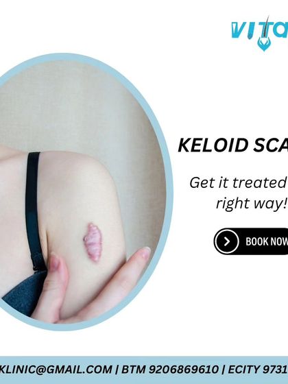 Vitals Klinic - Dermatosurgery (Minor Procedures) Scar Revision & Resurfacing photo 4