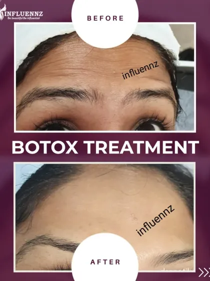 Forehead lines are a common concern, but the solution can be simple and effective. This before and after shows how Botox can smooth the skin for a refreshed and natural look, without freezing your expressions. The treatment is quick, taking about 15 minutes with no downtime.