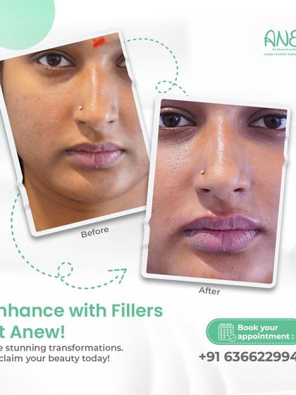 This before-and-after shows the transformative power of fillers. Here, lip fillers were used to enhance natural beauty, creating fuller, more defined lips and a youthful smile.