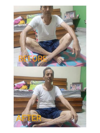 This image shows a clear improvement in posture and flexibility after just six days of dedicated yoga therapy practice. Even small, consistent efforts can bring significant changes.