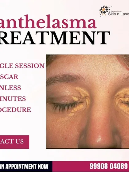 This graphic details the benefits of our Xanthelasma treatment: it's a single-session, no-scar, painless, two-minute procedure.