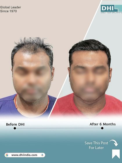 A frontal before and after of the same client at the 6-month mark. The significant improvement in coverage and density highlights the effectiveness of our DHI procedure for Norwood Grade V hair loss.