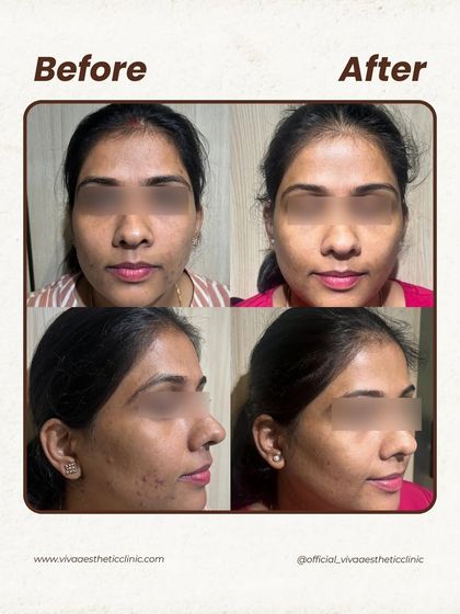 This before-and-after showcases a successful acne treatment journey. By creating a personalized plan, we were able to clear active breakouts and improve overall skin texture, restoring her confidence.