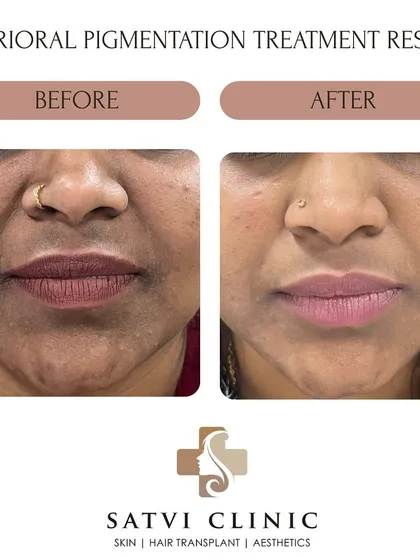 This patient was treated for Perioral Melanosis, which is the clinical term for darkening of the skin around the mouth. You can see a visible lightening of the hyperpigmentation and a more even skin tone after a course of dermatologist-guided depigmenting therapy and a strict sun protection regimen.
