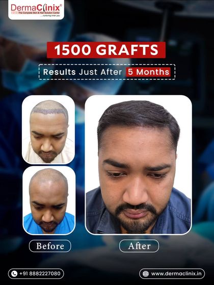 This collage displays the before, the immediate post operative state, and the five month result of a 1500 graft transplant. It illustrates the journey from baldness to a fuller head of hair.