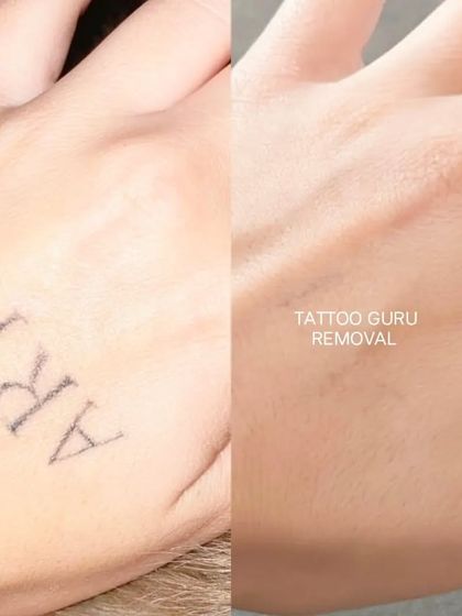 A simple word tattoo, 'ART', removed from the hand. This demonstrates how even simple line tattoos can be cleared away completely.