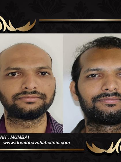 This patient also had significant hair loss across the top of his scalp. The 'after' photo shows a remarkable transformation with a full, dense result.