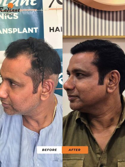 A side-profile view showing the restoration of a natural temple and sideburn angle. Creating a seamless transition from the front to the sides is key for a truly natural-looking hair transplant.