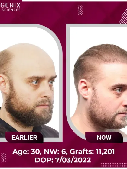 A stunning DHT hair restoration for a 30-year-old with Grade 6 baldness, requiring 11,201 grafts.