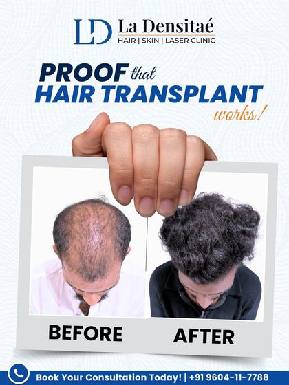 They said hair transplants should look natural, and I took that promise seriously. Nikhil Jankar’s result shows a natural hairline and excellent density, blending in so well you forget a procedure ever happened. This is the power of the RT-FUE technique.