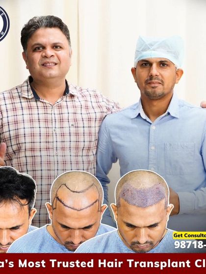 This patient came to me with Level 3 baldness. Using 3300 grafts, we addressed his frontal hair loss and recreated his hairline. The collage shows the journey from planning to the post-surgery result.