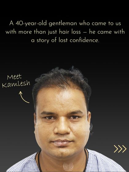 Meet Kamlesh, a 40-year-old gentleman who came to us with more than just hair loss. He came with a story of lost confidence, and we were determined to help him write a new chapter.