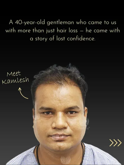 Meet Kamlesh, a 40-year-old gentleman who came to us with more than just hair loss. He came with a story of lost confidence, and we were determined to help him write a new chapter.