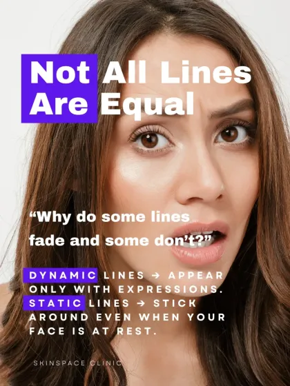 Not all lines are equal. Dynamic lines appear with expressions like smiling or frowning. Static lines are the ones that stick around even when your face is at rest, caused by long-term collagen loss.