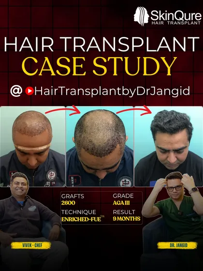 This is a detailed case study of Chef Vivek, who had Grade III hair loss. With 2600 grafts, we restored his hairline and confidence. The 9-month result is a testament to the EnRiched-FUE technique.