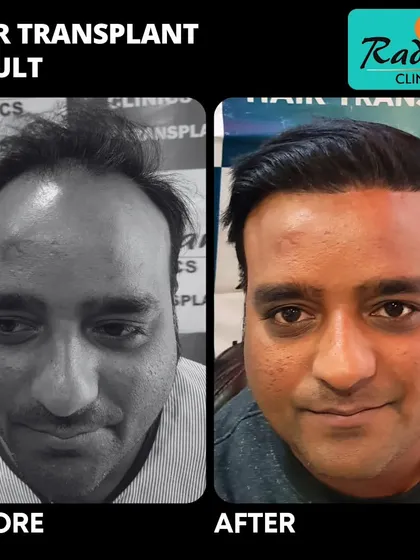 This before-and-after comparison highlights the successful restoration of a patient's hairline and overall density, resulting in a much more youthful and confident look.