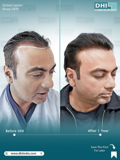 A side-profile view of the same client one year after his procedure. The hairline is perfectly designed to frame the face naturally, showcasing the artistic skill of our DHI-certified surgeons.