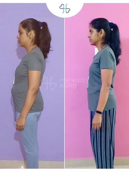 This client learned about Diastasis Recti after her pregnancy and decided to take action. In 12 weeks, she lost 6 kgs and significantly improved her core strength by focusing on portion control and targeted exercises.