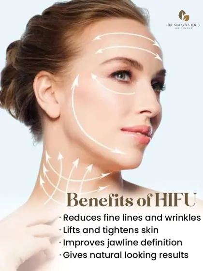 The benefits of a HIFU treatment are significant. It reduces fine lines and wrinkles, lifts and tightens sagging skin, and improves jawline definition, all while delivering natural-looking results.