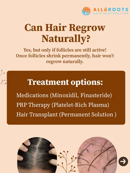 Can hair regrow naturally? Yes, but only if the follicles are still active. Once follicles shrink permanently, medical intervention is required. Treatment options include medications like Minoxidil, PRP therapy, or a permanent hair transplant.