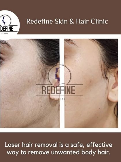This simple before and after comparison clearly shows the effectiveness of our laser hair removal treatment on facial hair, resulting in clean and smooth skin.