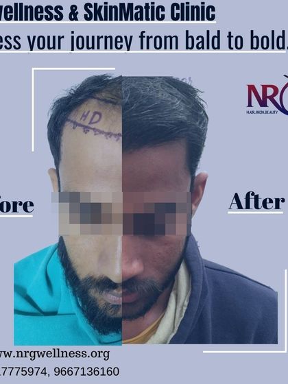 A side-by-side comparison illustrating the journey from bald to bold. We focus on creating a seamless and natural look that makes it impossible to tell a procedure was done.