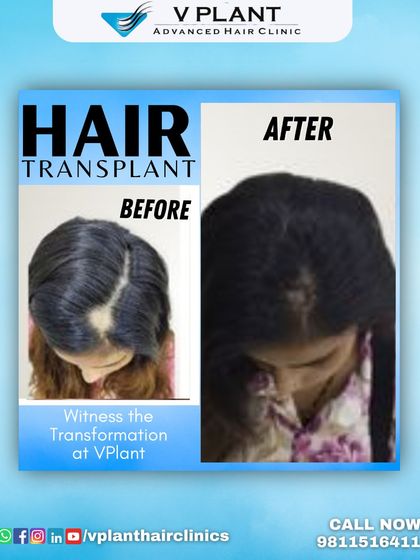 A clear before-and-after comparison for a female client, showing how we effectively address hair thinning and bald patches to restore a fuller, healthier look.