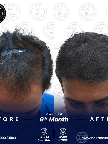A view from the top, 6 months into the growth phase. The BIO FUE method has delivered substantial density and coverage.