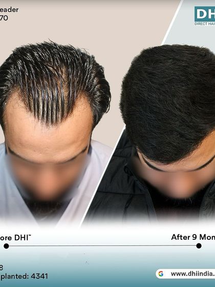 A top-down view of the 9-month result. This angle highlights the seamless flow and density from front to back, a testament to the meticulous work of our doctor-led team.