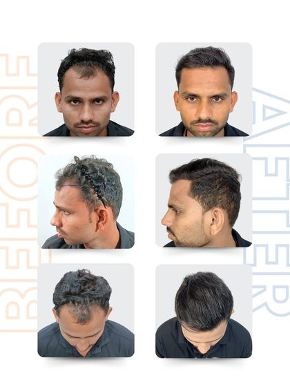 This multi-angle view demonstrates what a real transformation looks like. From consultation to the final result, my patients are in the hands of a specialist who delivers results that speak for themselves.