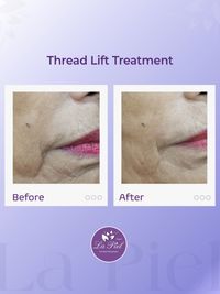 Advanced Anti-Aging & Facial Contouring
