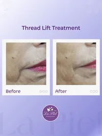 Advanced Anti-Aging & Facial Contouring