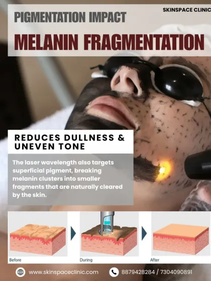 The laser also works deeper to break up superficial melanin clusters. This process of melanin fragmentation helps reduce dullness and uneven skin tone, leading to a brighter complexion over time.