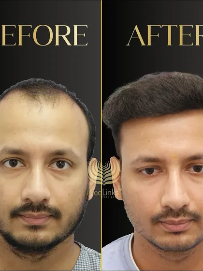 A powerful before and after transformation. We restored this patient's hair, giving him a fuller, more youthful look.