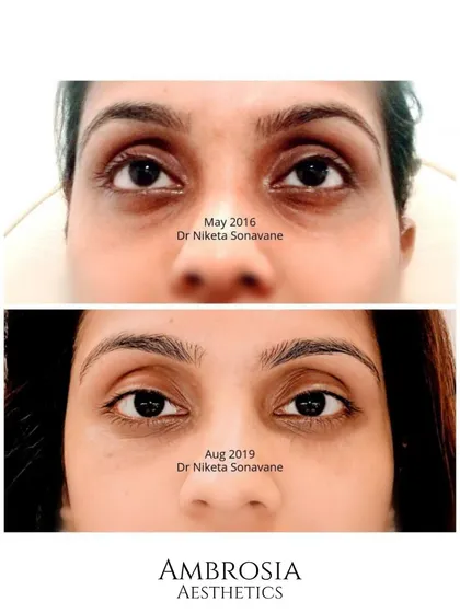 This transformation shows the power of under-eye fillers. By carefully restoring volume to the tear trough area, we can instantly reduce the appearance of hollows and dark circles, making you look more rested and rejuvenated.